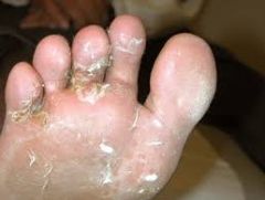 FUNGAL

"feet"
- moisture, poor vent in shoes
- can cause t. cruris
- may be a/w onychomycosis
- macerated hyperkeratotic plaques in interdigital webs OR dull redness w/ scaling on plantar

Tx: topical econazole, severe: oral, KEEP DRY!