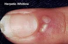 VIRAL

- skin infection of finger(s) caused by herpes I or 2
- direct contact

Tx: self-limiting