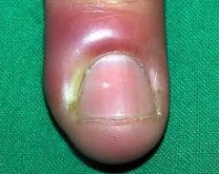 - Acute local BACTERIAL skin infection of proximal or lateral nail folds that resolves after abscess drains
- Chronic cases a/w on onychomycosis

Tx: soak warm water (20min, 3x/day), apply topical abx, abscess I&D 