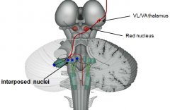 Interposed nucleus = emboliform + globus nucleus
- terminates [interposesed nucleus]
- peduncle [superior cerebellar - descending limb]
- function [comparator - adjusts limb position]