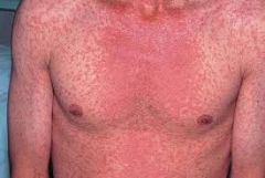 BACTERIAL
- "sandpaper" rash on face, neck, trunk, arms, legs 
- strep throat, pharyngitis
- strawberry tongue

Tx: PCN