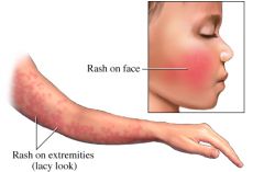 Parvovirus 19
- 5-15yo
- URI sx 1st

RASH
1. slapped cheeks
2. maculopapular rash on extremities
3. rash subsides, painful/swollen joints