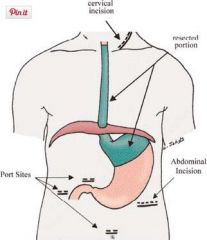 abdominal and neck incisions, blunt dissection of esophagus into thorax.  

Mortality from leaks decreased with cervical anastamosis