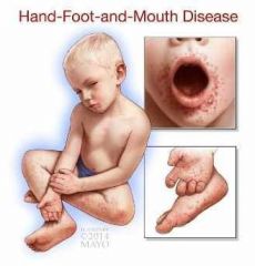 VIRALaka hand, foot, mouth dz
- Enterovirus
- sore throat, rash, blisters
- fever, oral vesicles on buccal mucosa & tongue
- lesions on palms, plantar surface of feet, buttocks
