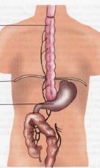 use colon based on marginal vessels as esophageal replacement.  Need to make three anastamoses (preserves gastric function in young ppl)