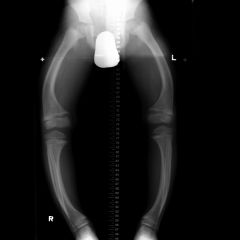 Deep BORING pain with bony deformity & enlargement 


= Pelvis / Lumbar Spine / Skull / Femur / Thoracic Spine / Tibia (Bowed Sabre Tibia) 