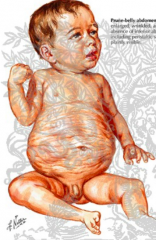 - Prenatal accumulation of fluid in lower abdomen d/t urinary system anomalies may interfere w/ development or cause degeneration of abdominal muscles
- After birth, the abdominal distention is reduced causing skin over area to be very wrinkled