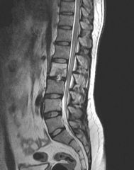  A 33-year-old man with a history of IV drug abuse presents with low back pain of increasing intensity. His neurologic examination is intact. Laboratory studies reveal a WBC count of 11,000/mm3 and erythrocyte sedimentation rate of 82 mm/h. Blood...
