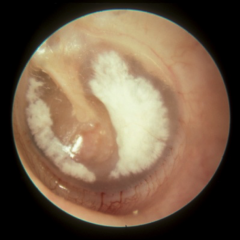 Scarring of the TM and middle ear


 


Scarring of TM only 