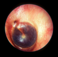 Blood in middle ear space typically caused by trauma