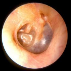 Parts of TM that are retracted or sucked into the middle ear space 