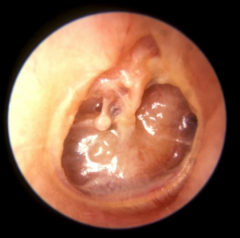 Severe retraction/collapse of the TM, thin/weak and stuck to middle ear floor


 


CHL