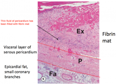 This is acute fibrinous inflammation where the exudate has high plasma protein content and fibrinogen is converted to fibrin and deposited in the tissues. 
Often occurs with serous membrane-lined cavities (pleural, pericardial and peritoneal) and the fib