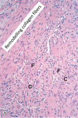 This is vascular granulation tissue where fibroblasts (F) are secreting collagen. The collagen then remodels in response to tensile stress (fibrous granulation tissue). Over months and years, the cellularity of the scar diminishes and there is loss of cap