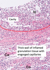 If acute inflammatory response fails to destroy/remove cause of tissue damage. The damage continues and produces pus and fibrin tissue from acute inflammatory response. A chronic abscess occurs when the cavity becomes encapsulated by fibrous tissue (wall 