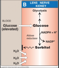 High glucose levels results in lens converting glucose to sorbitol (via aldose reductase). 
Sorbitol increased water content in the lines and results in cataract.