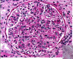 Renal corpuscle with edema and increased in cellularity due to inflammation.