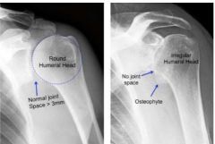Etiology: Genetic (ex: type 3 acromion), or related to UE overuse
Symptoms: Pain in various locations of shoulder, limited ROM and strength, crepitus (crunching sound) during shoulder movement, can include impingement
Diagnosis: X-ray can confirm...