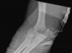 pt sustains the injury in Fig from a gunshot injury. The PE is notable for lack of sensation in his fourth and fifth digits as well as a positive Froment's sign. Which of the following factors has not been shown to be a significant prognostic indi...