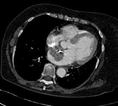 Atrial myxoma- benign primary cardiac tumor