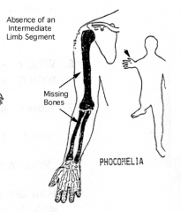 Babies were at high risk for Phocomelia (or seal limb) where distal segment of limb is attached to a more proximal segment w/ intervening segment missing or directly attached to girdle