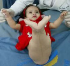 - More severe and very rare birth defect
- Fused limb fields or abnormal development of tailbud
- 1/25,000 - 50,000