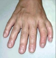 - Duplication of limb parts, especially digits
- Inherited (autosomal dominant or recessive)
- Usually bilateral