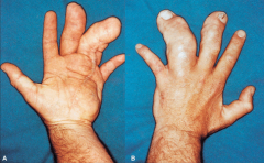 - Very rarely some parts of limb become hypertrophied
- Macrodactyly or large digit
- Usually not bilateral