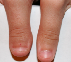 Brachydactyly - digit is shortened due to lack of certain joints