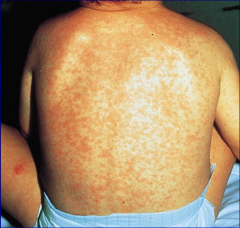 An eruption comprised of either macules coalescing into patches or papules coalescing into thin plaques.