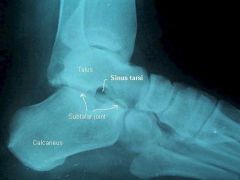 this joint = talus plus calcaneous, the motion is only inversion/eversion there is no plantar flexion or dorsiflexion