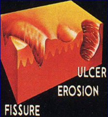 A deep linear split through the epidermis into the dermis: a linear ulcer
