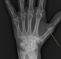 Bone embedded in a tendon where the tendon passes over a joint