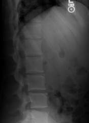 What is shown in this image (look at the corners of the vertebrae)?