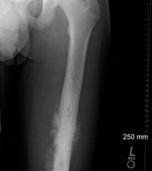 Osteosarcoma = malignant (not well defined)