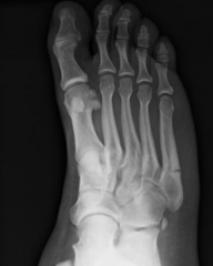 Jones fracture (a fracture of the diaphysis of the fifth metatarsal of the foot)