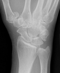 Rolando Fracture (intra-articular fracture through the base of the first metacarpal bone - the bone located just proximal to the thumb)
