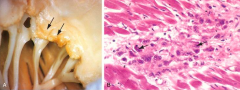 In RF, vegetations alone line of closure of affected valve is called ________. Myocarditis with focal inflammatory lesions are called _______. Modified myocytes that look like "caterpillar cells" are called _________.