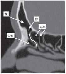 Anteriorly: frontal process of the maxilla
Superiorly: frontal recess or sinus
Anterolaterally: nasal bones
Inferolaterally: lacrimal bone
Inferomedially: uncinate process of the ethmoid bone