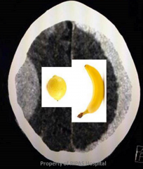 Subdural haemorrhage
Compression of the brain but no infiltration in sucli and fissures and banana–shaped