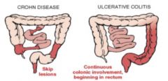 Ulcerative and inflammatory disease of the bowel that results in poor absorption of nutrients. Acute ulcerative colitis results in vascular congestion, hemorrhage, edema, and ulceration of the bowel mucosa. Chronic ulcerative colitis causes muscul...