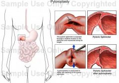Enlarging the pylorus to prevent or decrease pyloric obstruction, thereby enhancing gastric emptying


 


 


 


 


 