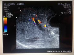 You obtained this color Doppler image during a hepatic sonogram.  There is no color signal detected within the portal vein.  What can you do to improve sensitivity to slow flow?


A. Increase wall filter
B. Decrease packet size
C. Decrease color g...