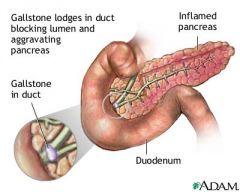 An acute or chronic inflammation of the pancreas, with associated escape of pancreatic enzymes into surrounding tissue.


Acute pancreatitis can occur suddenly as one attack or can be recurrent with resolution.


Chronic pancreatitis is a cont...