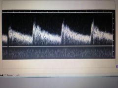 What Doppler control should be adjusted to optimize this Doppler spectral waveform?



A. Wall filter
B. Packet size
C. Gain
D. Pulse repetition frequency
E. Baseline