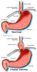A portion of the stomach that herniates through the diaphragm and into the thorax. Herniation results fro weakening of the muscles of the diaphragm and is aggravated by factors that increase abdominal pressure, such as pregnancy, ascites, obesity,...