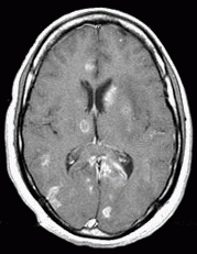 Most likely Toxoplasma gondii from raw/undercooked meat or cat litter. Primarily causes brain abcesses. Patients can be treated with Pyrimethamine/sulfadiazine and all patients with a CD4
