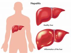 Inflammation of the liver caused by a virus, bacteria, or exposure to medications or hepatotoxins


 


 


 