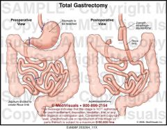 Removal of the stomach with attachment of the esophagus to the jejunum or duodenum; also termed "esophagojejunostomy" or esophagoduodenostomy.


 


 