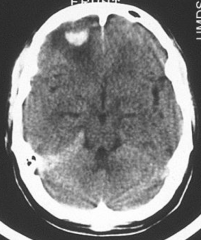 Name a likely mechanism for this intracranial haematoma